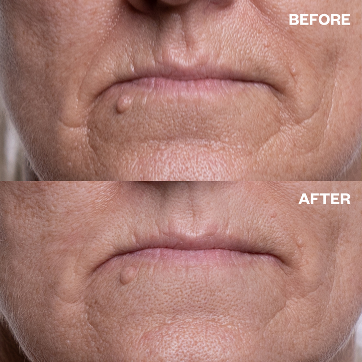 Mouth Wrinkle Patches