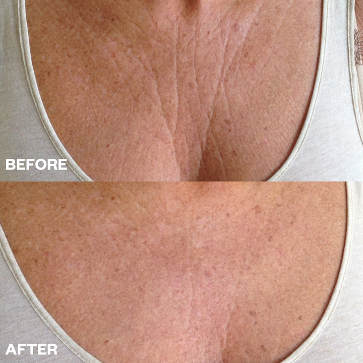 Chest Wrinkle Patch